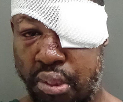 Markeith Loyd is permanently blind in his left eye